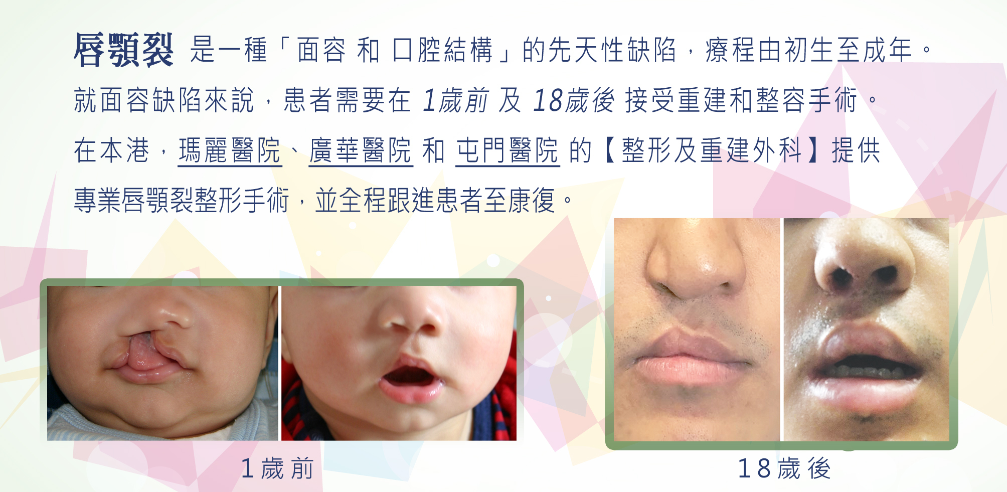 https://www.cleftlip.org.hk/wp-content/uploads/2024/11/2_Different-stage-of-plastic-surgeries-14.jpg