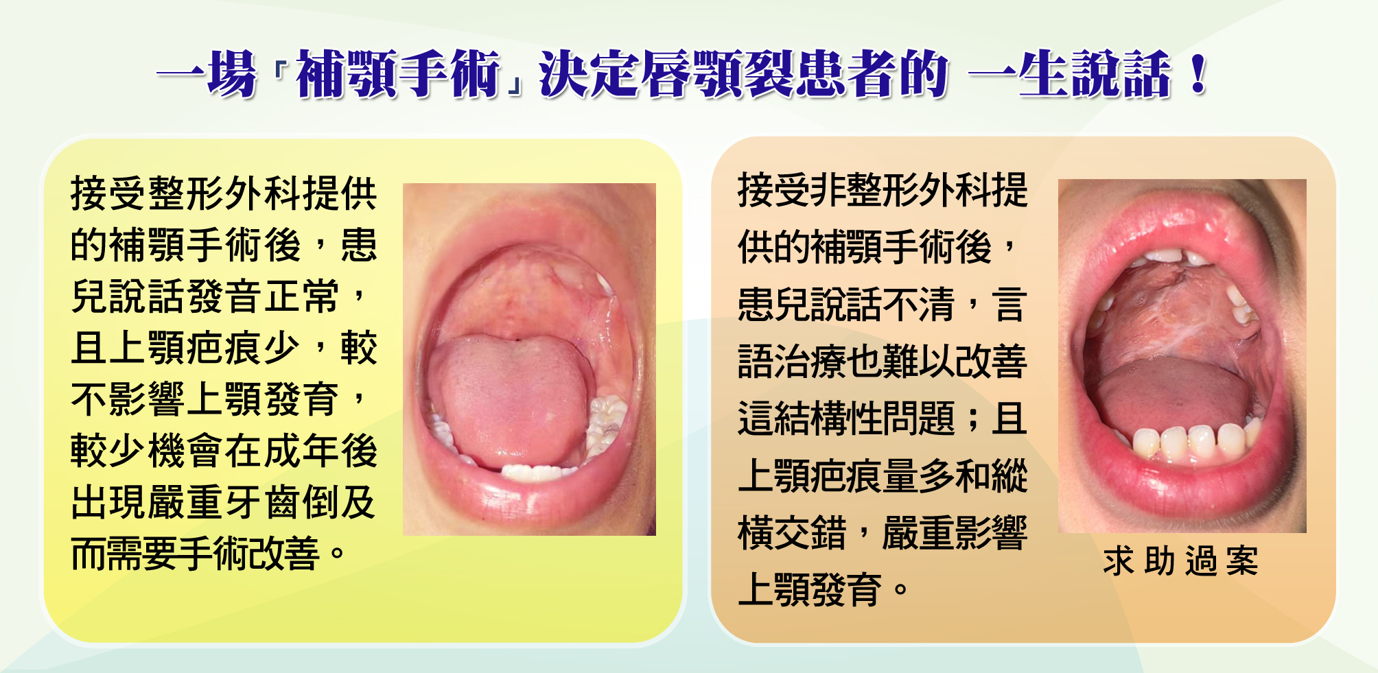 https://www.cleftlip.org.hk/wp-content/uploads/2024/11/4_Bad-good-palate-repair-13.5-1.jpg