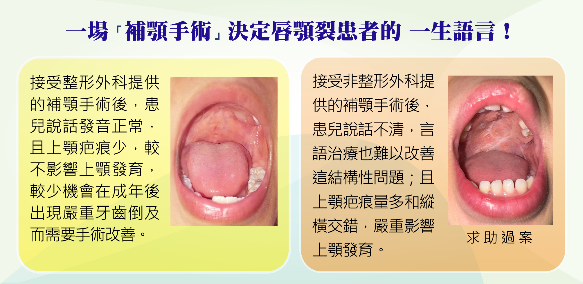 https://www.cleftlip.org.hk/wp-content/uploads/2024/11/4_Bad-good-palate-repair-13.5.jpg